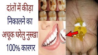 सिर्फ एक बार इस्तेमाल से दांत का कीड़ा बाहर निकालें  How To Get Rid Of Tooth Cavity 100 Effective [upl. by Adelia]