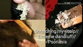 Scratching my scalp Extreme dandruff psoriasis [upl. by Gereld]