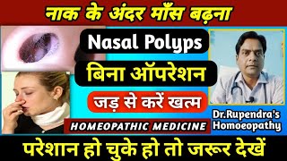 नाक के अंदर माँस बढ़ना। Nasal Polyps Treatment Without Surgery। Nasal Polyps Homeopathic Medicine। [upl. by Nosahc42]