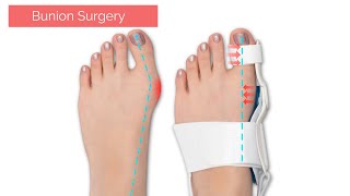 Bunion Surgery  Bunion Correction in 3D Animation [upl. by Ellerrehc]