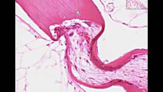 Histopathology BoneHyperparathyroidism [upl. by Thenna124]