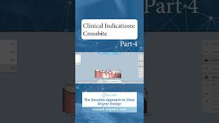 Clinical Indications Crossbite Part 4 [upl. by Svetlana]