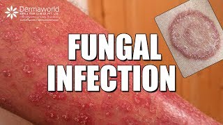 Suffering from Fungal Infection Ringworms WATCH THIS [upl. by Anillek960]