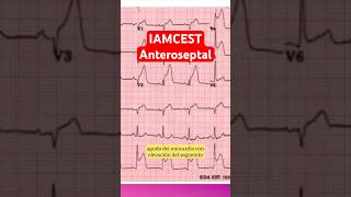 Infartó anteroseptal en el ECG medicina [upl. by Aldwon]