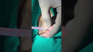 Safely Removing a Earring Stuck in the Back of the Ear  Dr Shailesh Pandey entspecialist ent [upl. by Eisseb381]