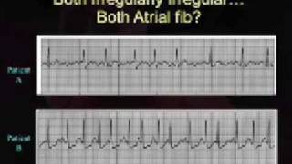 Intro EKG Interpretation Part 3 [upl. by Enitsirk]