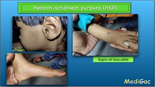 HenochSchonlein PurpuraHSP  Clinical features  Pathophysiology  Diagnosis and Treatment [upl. by Conroy]