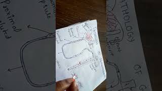 pathogenesis of glomerulonephritis [upl. by Pamela]