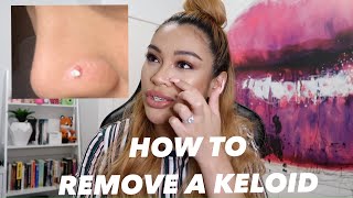 HOW I REMOVED MY NOSE PIERCING BUMP KELOID FAST [upl. by Ydualc36]