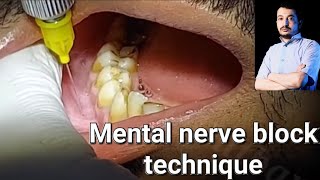 Local Anesthesia Mental Nerve block technique Mandibular Anesthesia Techniques dentistry [upl. by Hopper]