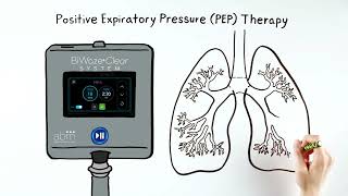 BiWaze® Clear Hospital Animation  Annas Story [upl. by Odragde]