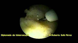 histeroscopia miomectomia con versapoint [upl. by Nnylak]