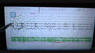 Sleep Study Scoring on Person with Severe Sleep Apnea and snoring Polysomnograph [upl. by Eneli]