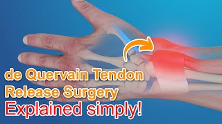 De Quervain Tendon Release Surgery  Explained [upl. by Sherborn406]