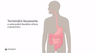 Terminální ileostomie a odstranění tlustého střeva a konečníku [upl. by Aihk]