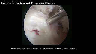 Arthroscopic Fixation With Absorbable Suture Anchors for Pipkin Type I Femoral Head Fractures—Letter [upl. by Lauretta93]