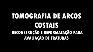 FRATURA DE ARCOS COSTAIS NA TC RECONSTRUÇÃO MPR [upl. by Ettenrahc554]