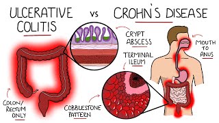 Inflammatory Bowel Disease  Ulcerative Colitis v Crohns Disease With Histology amp Manifestations [upl. by Block]