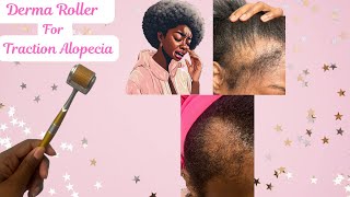 How to use a Derma Roller for Traction Alopecia [upl. by Elyrehc415]