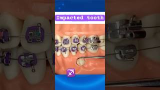 Impacted tooth during Braces [upl. by Houlberg]