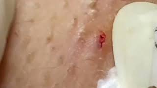 3 minutes remove very unique kind of blackheads 3 分鐘移除很特別的黑頭 [upl. by Eniamaj]