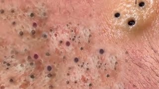 How To Get Rid Of Pimple Under Skin In 1 Week ✦ Dr Laelia ✦ [upl. by Roderich]