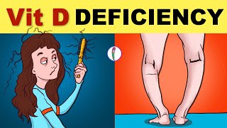 Vitamin D Deficiency  Vitamin D Deficiency Symptoms  Vitamin D Deficiency Rickets  Osteomalacia [upl. by Edva407]