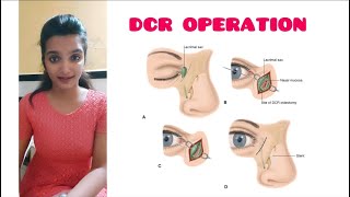 Dacryocystorhinostomy DCRsurgery Dacryocystitis Part 2 A K Khurana [upl. by Roter]