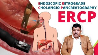 பித்தக்குழாய் என்டோஸ்கோப்பி  What is ERCP Procedure and How it is done  Dr John Grifson [upl. by Rintoul]