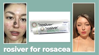 Rosiver Ivermectin Cream For Rosacea Review [upl. by Woodberry]