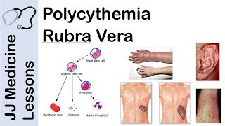 Polycythemia Rubra Vera  Pathophysiology Symptoms Diagnosis and Treatment [upl. by Hendrika85]