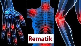 Rematik  Rheumatoid Arthritis  Penyakir Autoimun  Healthy  Belajar Ilmu Kesehatan [upl. by Eliezer93]