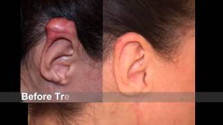 Best quotKeloid Treatmentquot for most difficult ear keloid [upl. by Ahsekat]