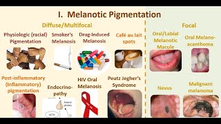 9 Wrap up of melanotic pigmentations [upl. by Ococ36]