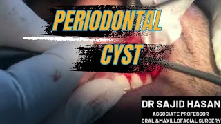 ENUCLEATION OF LATERAL PERIODONTAL CYST  ORAL SURGERY [upl. by Yahsel983]