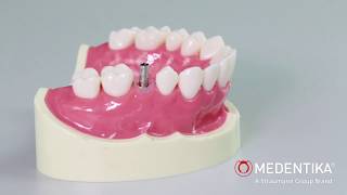 Precision Guide StepbyStep Removal of Broken Abutment Screw with MEDENTiKA® Tools 🛠️🔍🦷 [upl. by Debora]