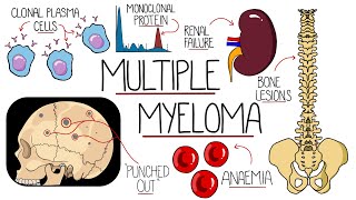 Understanding Multiple Myeloma Multiple Myeloma Explained Clearly [upl. by Rimidalv334]