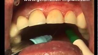 Incisive centrale  extraction implantation  technique flapless [upl. by Vivyan]