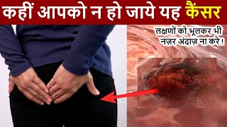 पेट में Colon Cancer के शुरुआती लक्षण  Early Warning Signs Of Colon Cancer You Should Not Ignore [upl. by Behre]