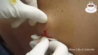 Pimple Pop React Huge Back Cyst [upl. by Safko]