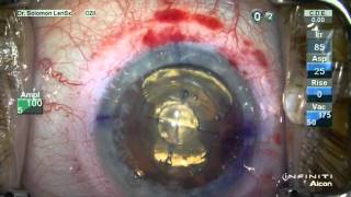 Watch LenSx Laser Cataract Surgery Performed by Dr Kerry Solomon [upl. by Westley]