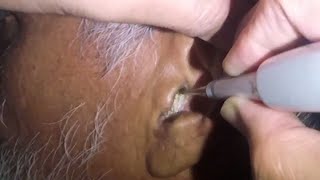 Smooth Earwax Removal After Application of Hydrogen Peroxide [upl. by Eltsyrhc]