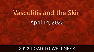 Vasculitis and the Skin [upl. by Ardeahp643]