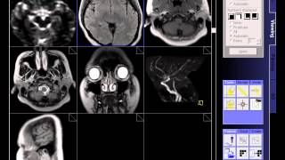 BRAIN MRI NORMAL [upl. by Ytisahc]