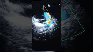 Patent Ductus Arteriosus ECHOCARDIOGRAM cardiacanatomy [upl. by Baelbeer]