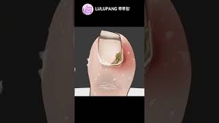 내성발톱 Ingrown Toenail Shorts [upl. by Schlessinger]