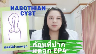 ก้อนที่ปากมดลูก ep4  Nabothian cyst  ถุงน้ำที่ปากมดลูก by หมอดาราวดี [upl. by Krall]