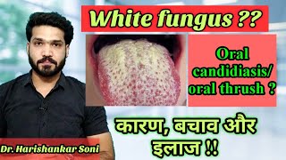 सफेद फंगस  Oral candidiasis  oral thrush  white fungus of mouth causes amp treatment [upl. by Aksel406]