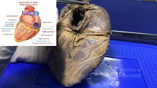 Blood supply of heart or Coronary circulation  Gross and clinical anatomy [upl. by Skippy283]