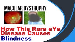 Macular Dystrophy hindi [upl. by Arocahs701]